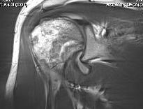 Shoulder AVN MRI